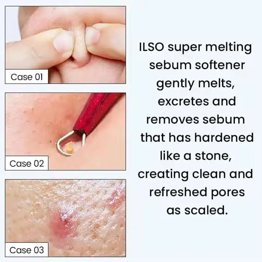 150ML Koorean Blackhead Extractor Toner Super Melting Sebum Softener Stronger Blackhead Cleansing ilso Moisturizing Facial Care Eternal Bloom Co